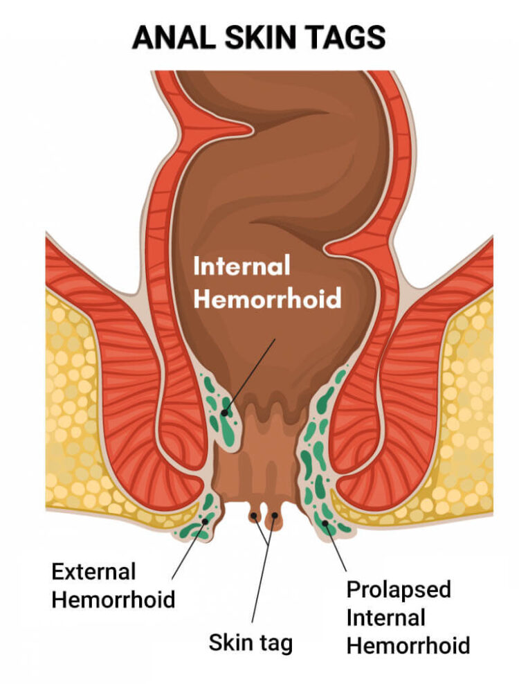 How To Prevent Anal Skin Tags From Developing Now Then Digital