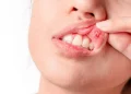 nowthendigital.com__causes Types-of-mouth-sores-oral sex