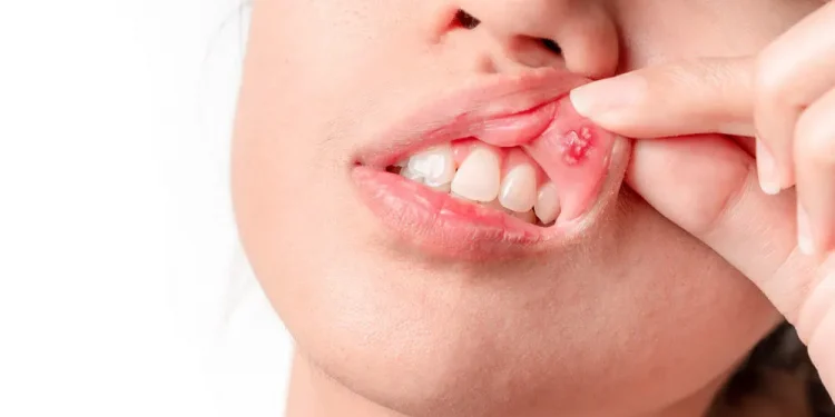 nowthendigital.com__causes Types-of-mouth-sores-oral sex