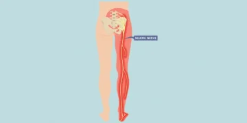 nowthendigital.com_symptoms-and-causes-of-Sciatica Nerve Pain