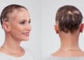nowthendigital.com-What is alopecia areata (1)