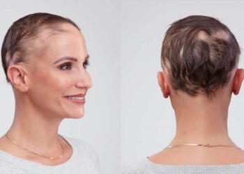 nowthendigital.com-What is alopecia areata (1)