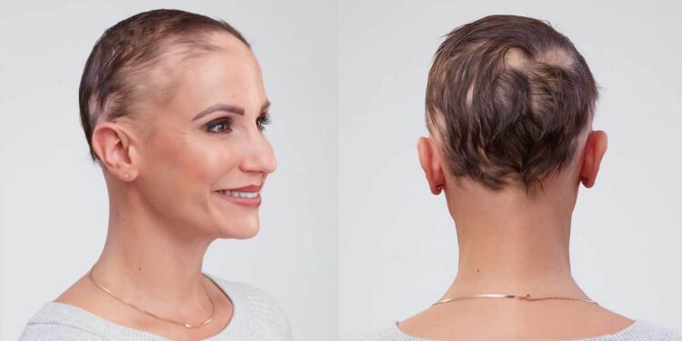 nowthendigital.com-What is alopecia areata (1)