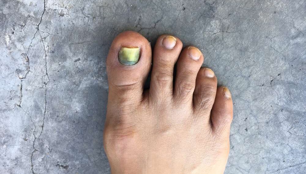 nowthendigital.com__Why are your toes turning black