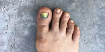 nowthendigital.com__Why are your toes turning black