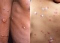 monkeypox vs chickenpox and smallpox (1)