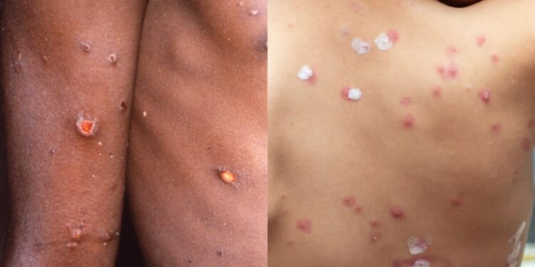 monkeypox vs chickenpox and smallpox (1)
