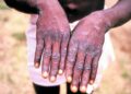 nowthendigital.com__the symptoms and signs of monkeypox (1)