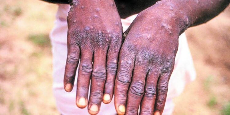 nowthendigital.com__the symptoms and signs of monkeypox (1)
