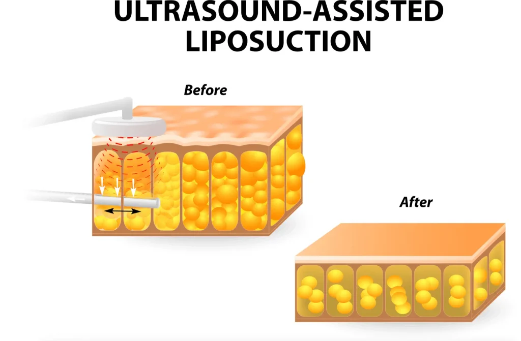 Ultrasound-assisted