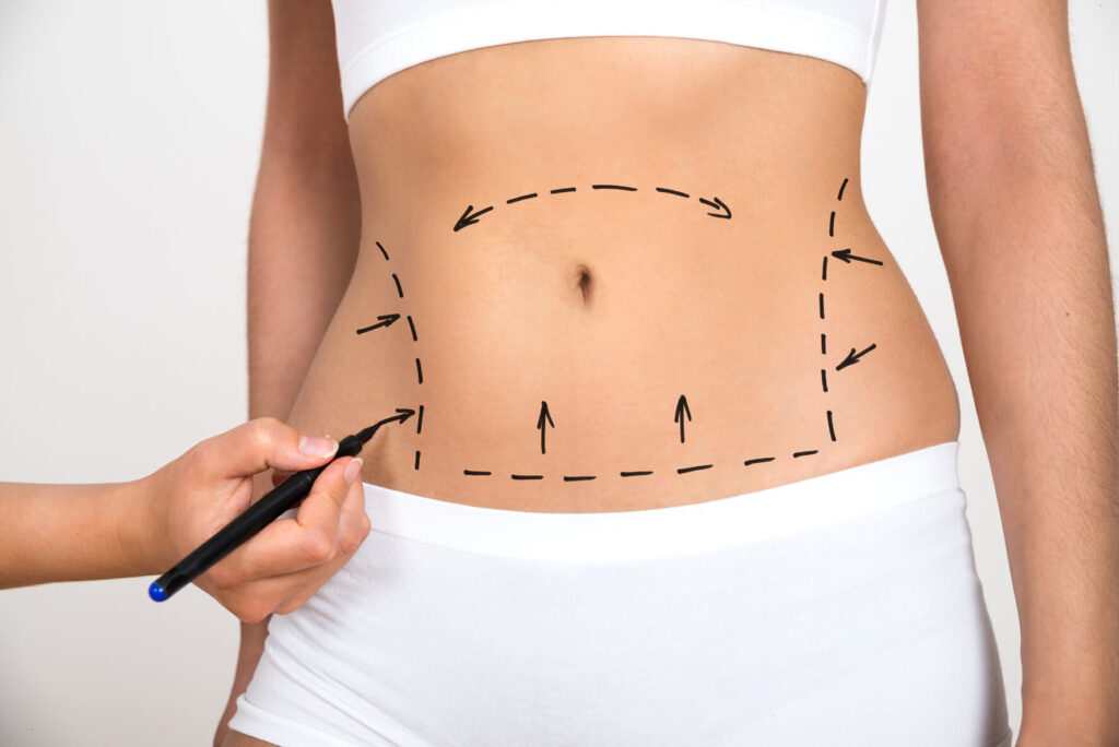 What is the cost of liposuction