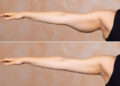 losing arm fat faster in 2 weeks