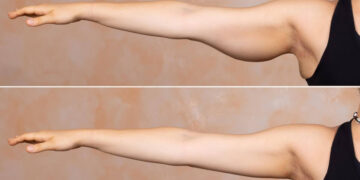 losing arm fat faster in 2 weeks