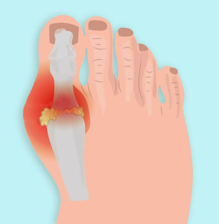 what causes gout in feet