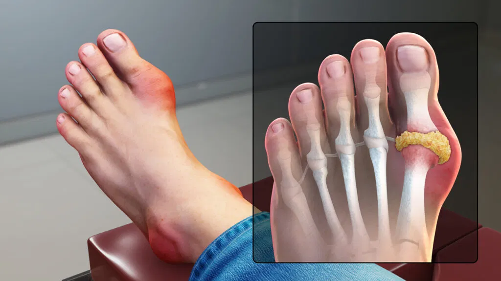 gouty arthritis in big toe