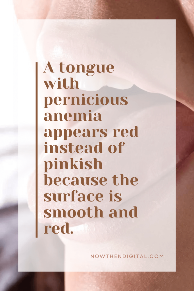 iron deficiency anemia tongue
