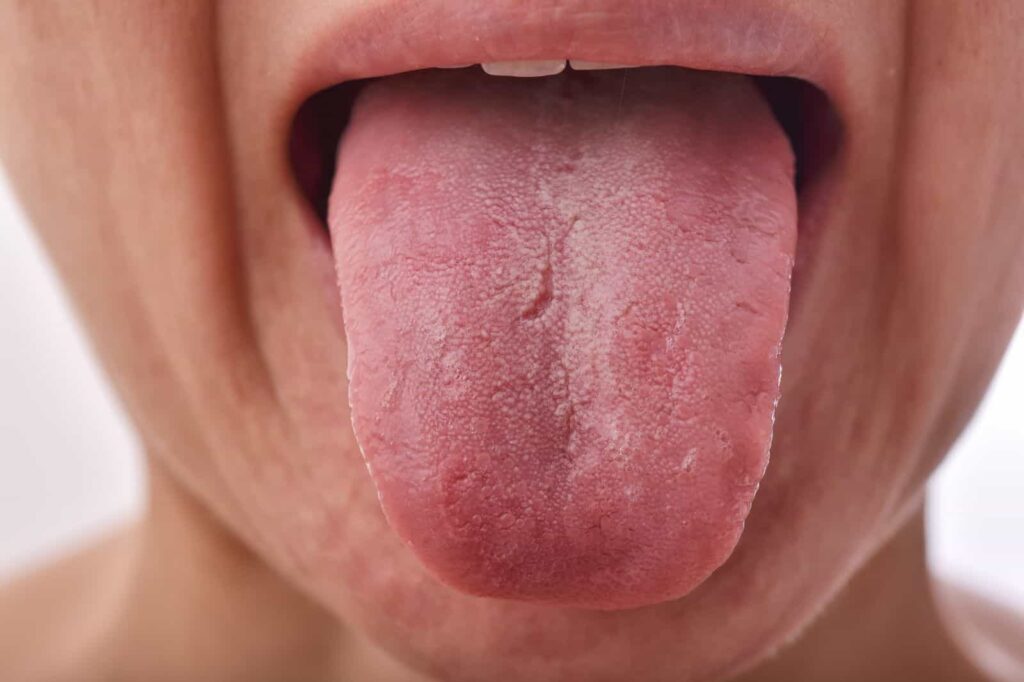 pernicious anemia tongue