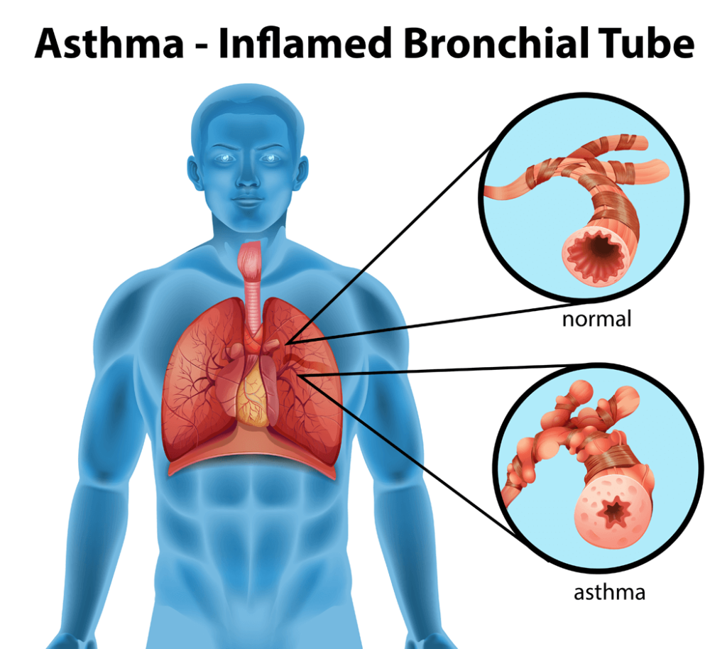 cause of asthma