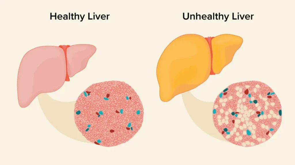 fatty liver disease