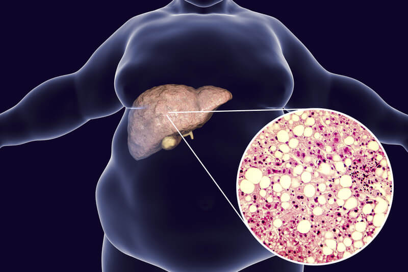 symptoms of fatty liver disease