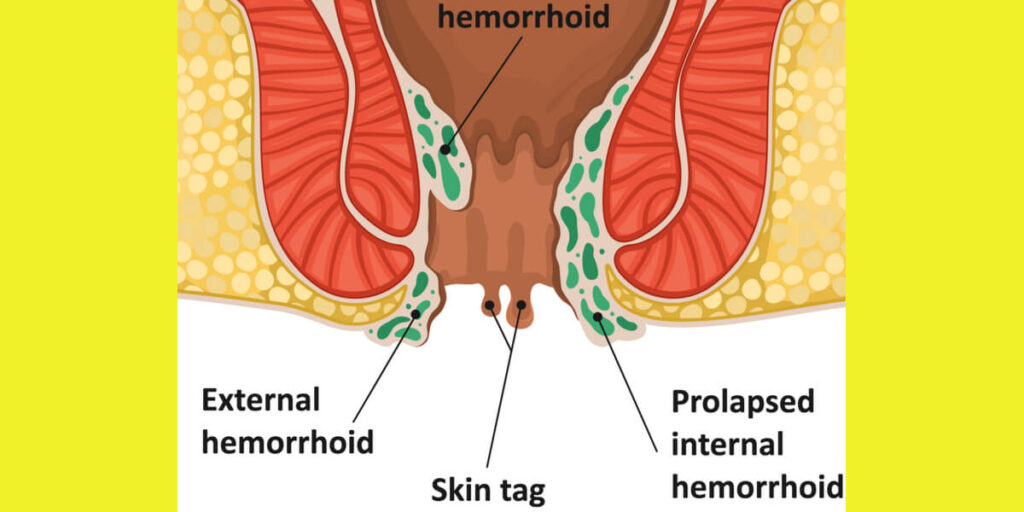 what do perianal skin tags look like