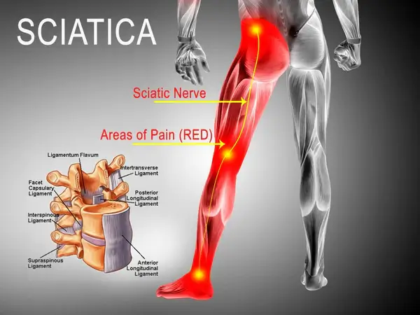 endometriosis sciatica