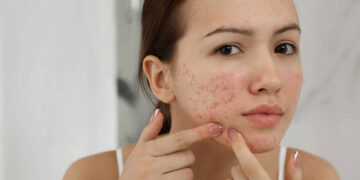 manage skin inflammation tips