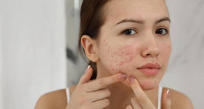 manage skin inflammation tips