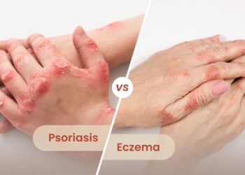 difference between psoriasis and eczema