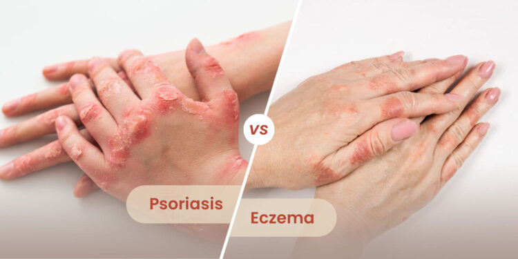 difference between psoriasis and eczema