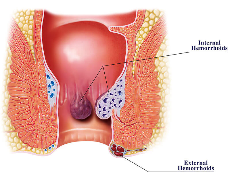 how to apply hydrocortisone cream for hemorrhoids