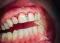 Gingivitis is inflammation of the gums