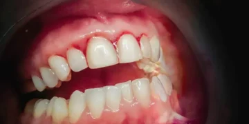 Gingivitis is inflammation of the gums