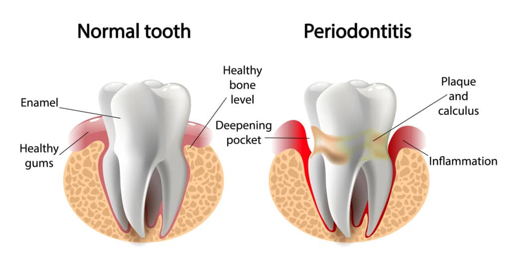 Periodontitis also called gum disease
