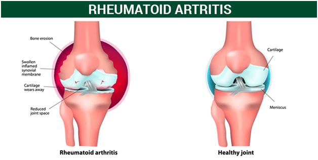 Rheumatoid Arthritis