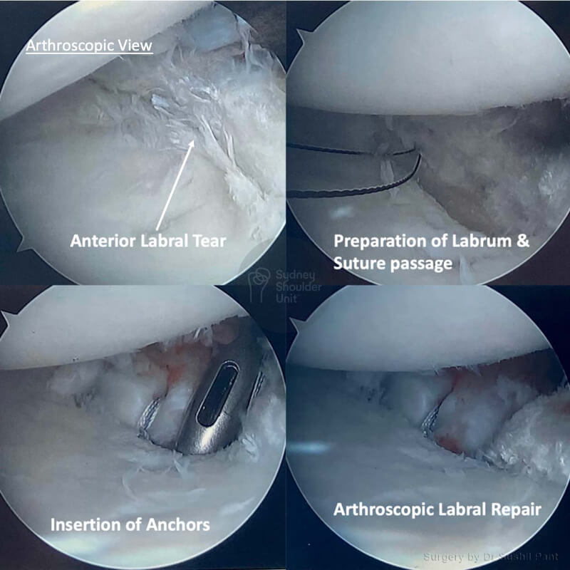 Shoulder Labrum Tear Test