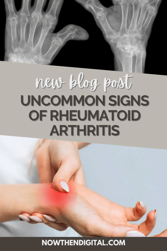 Uncommon Signs of Rheumatoid Arthritis