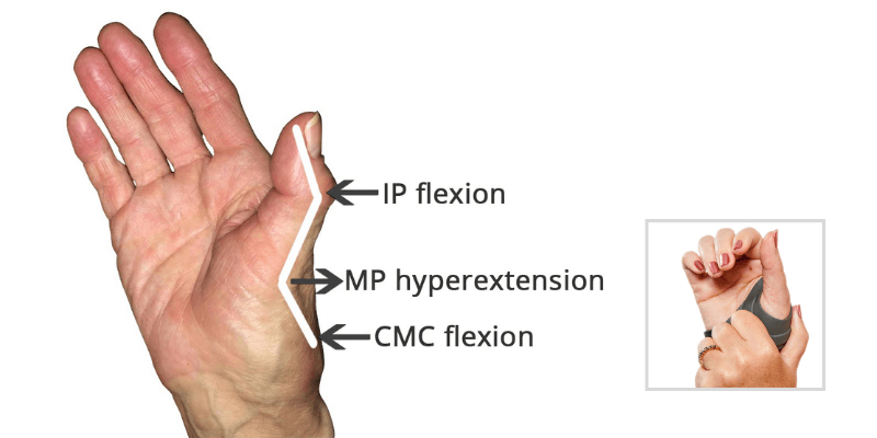 What is Rheumatoid Arthritis