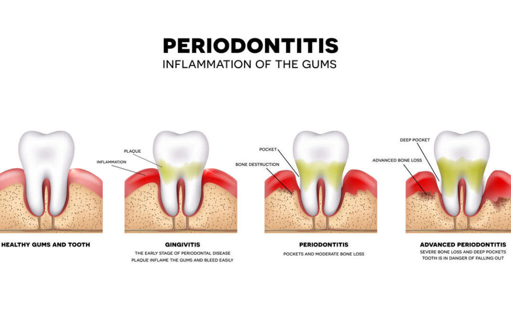 difference-gingivitis-and-periodontitis
