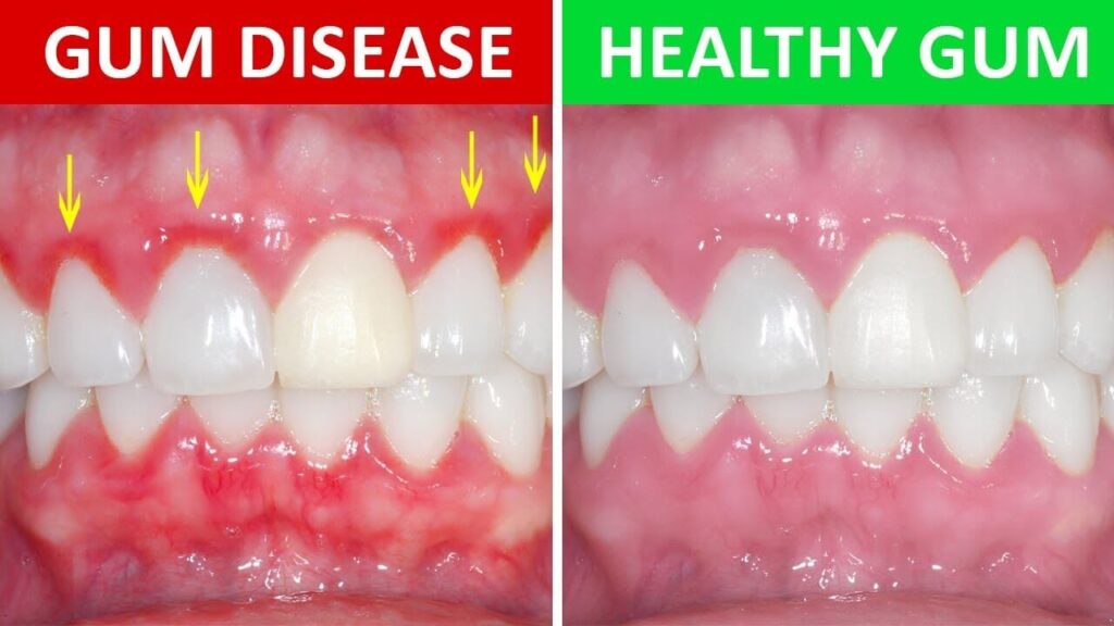 gingivitis before and after