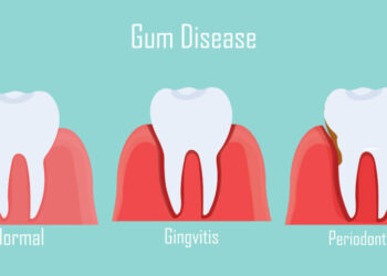 gingivitis vs periodontitis