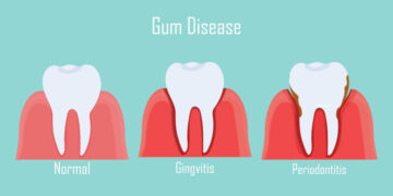 gingivitis vs periodontitis