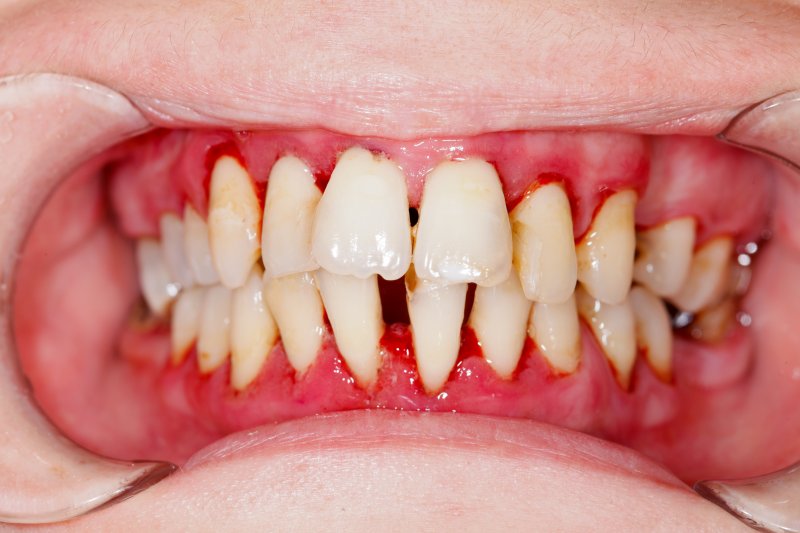 gingivitis vs periodontitis pictures