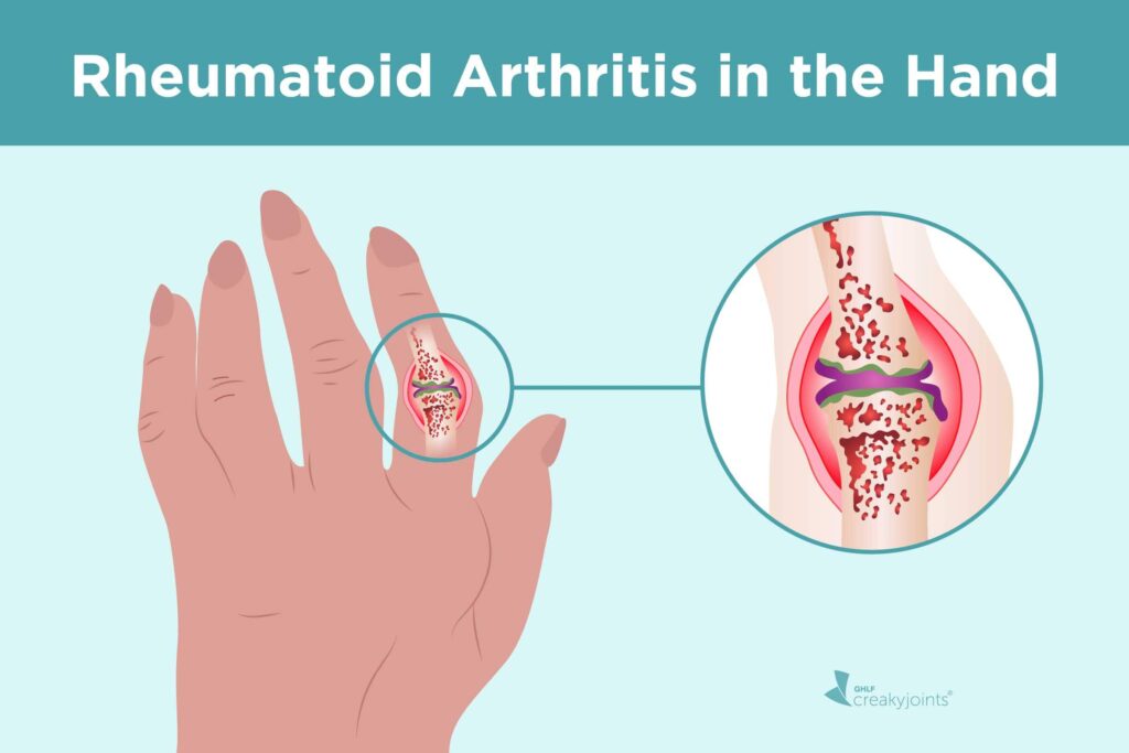 how do you know if you have rheumatoid arthritis