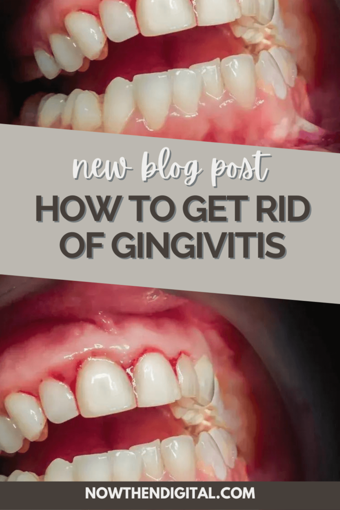 how to treat gingivitis