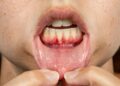 periodontitis treatment