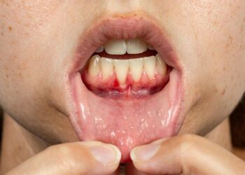 periodontitis treatment