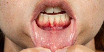 periodontitis treatment