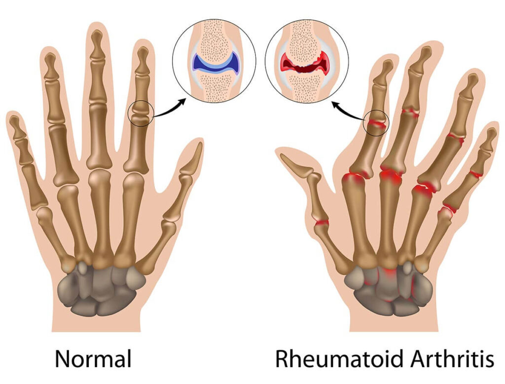 rheumatoid arthritis icd 10
