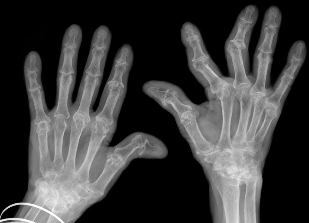 rheumatoid arthritis symptoms